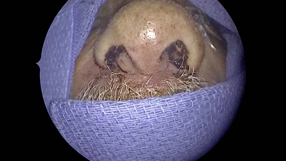 thumb_vk_Artsen_halen_150_levende_beestjes_uit_de_neus_van_een_man