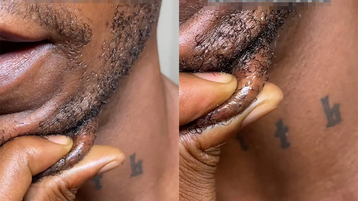 thumb_vk_Ingegroeide_haar_wordt_even_aangepakt