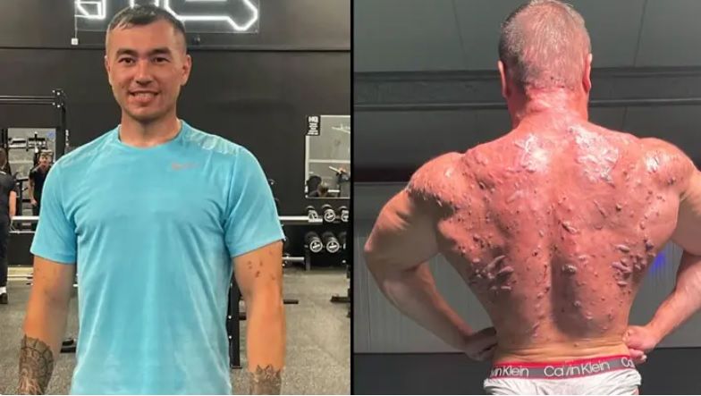 Bodybuilder toont ernstige schade die steroïden aan zijn lichaam hebben toegebracht