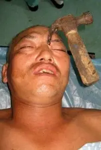 Chinese Builder Recovering After Hammer in the Head!