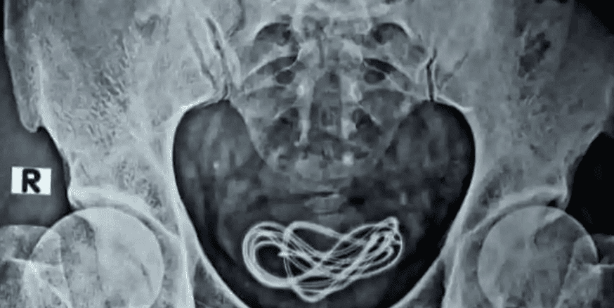 Shocking! Charging cable extracted from man's bladder