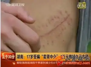 Chinese Teen Sells His Right Kidney For iPad 2!