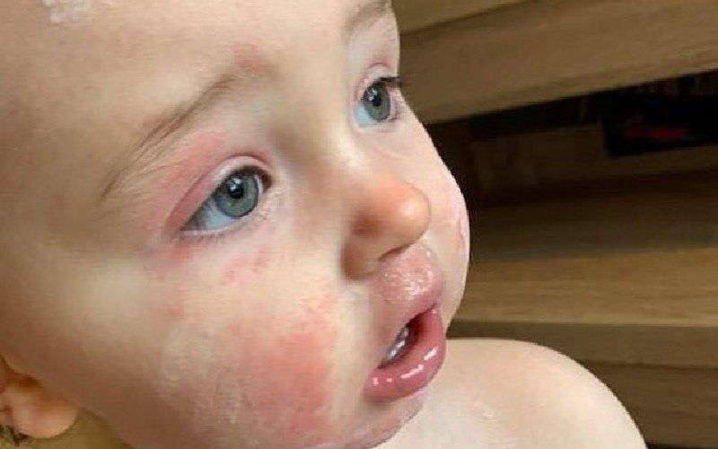 Mama waarschuwt andere ouders nadat zoontje (1,5) wekenlang aan zeldzame aandoening lijdt: "Hoge koorts, rode ogen en overal uitslag"