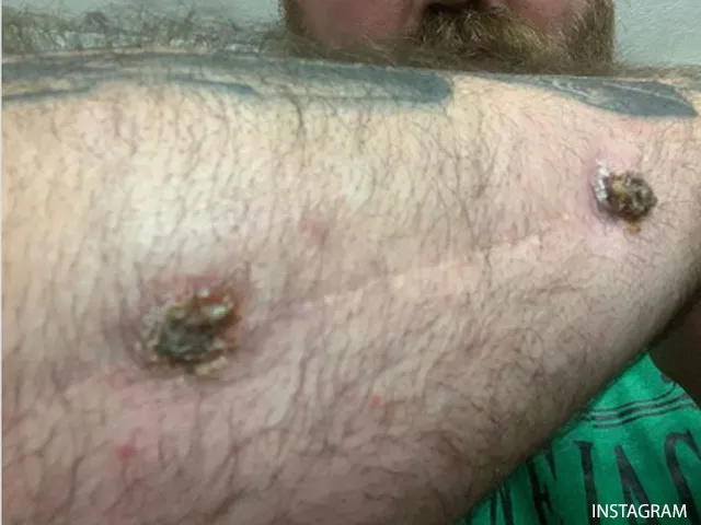 UFC-KAMPIOEN IN DE PROBLEMEN: Nare infectie duikt op na 16 jaar