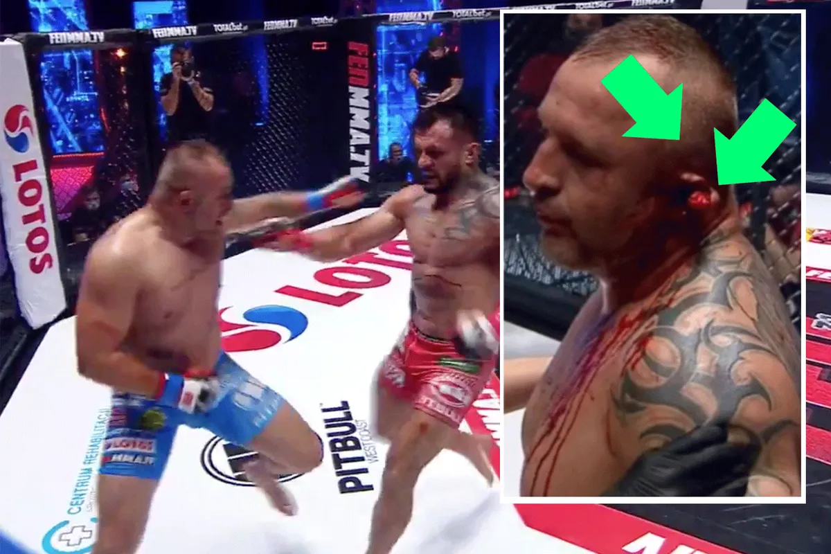 FLAPPIE: Dokter stopt heftig MMA-gevecht vanwege loshangend oor (video)