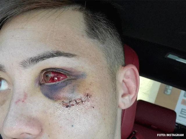 Illegale knie lijdt tot gruwelijk letsel bij MMA-vechter