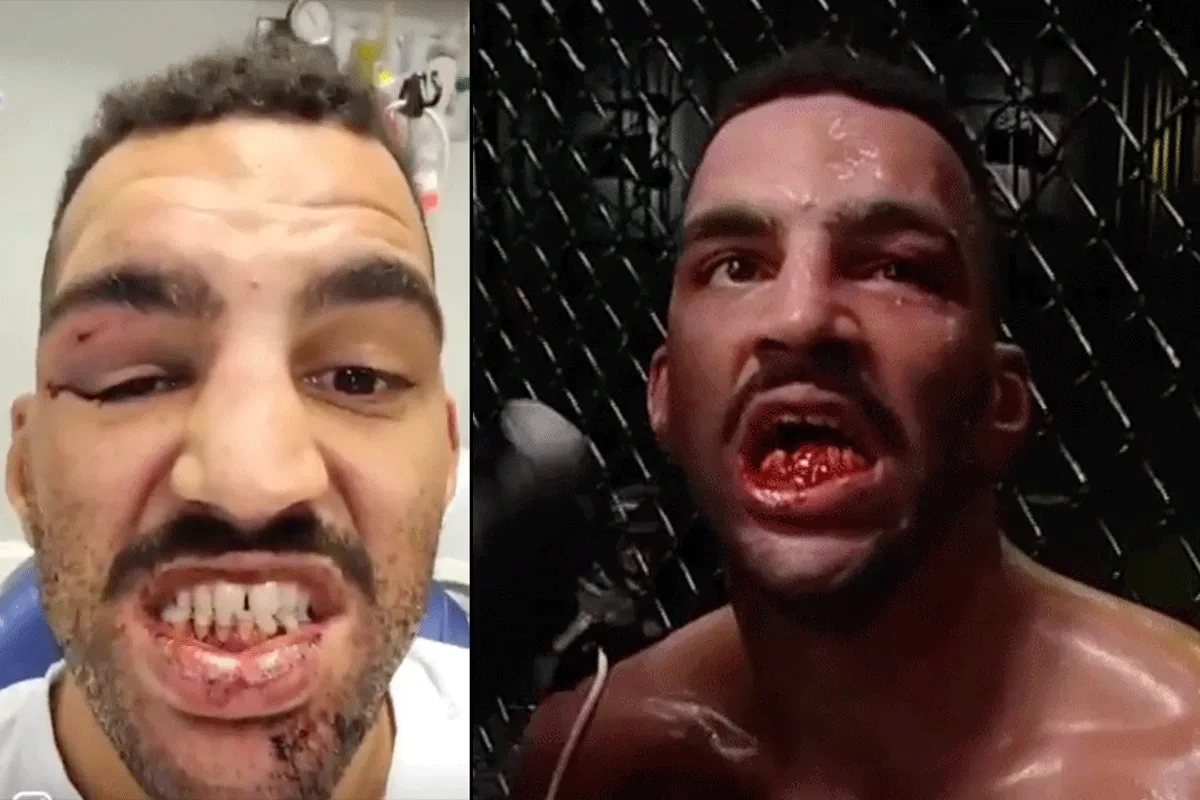 De tandjes! UFC'er geeft update over kapot geslagen gebit (video)