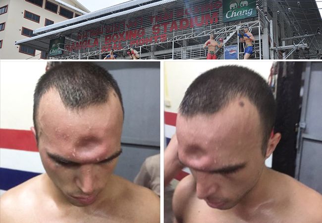 Muay Thai vechter loopt bizarre schedelbreuk op!