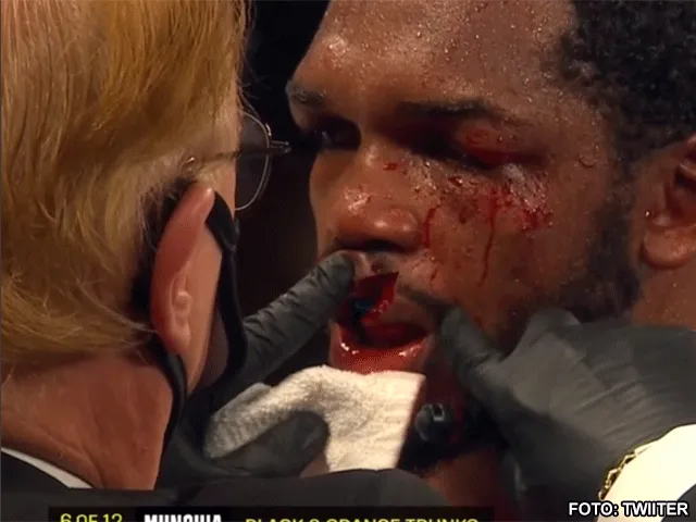 BLOED IN DE RING: Boksers lip in tweeën door uppercut