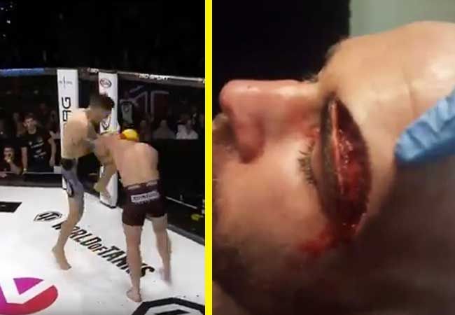 VIDEO | De bizarre blessure van MMA vechter Jack Mason