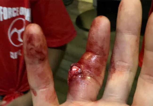 MMA-vechter loopt horror blessure op: 'verslaat alsnog tegenstander'