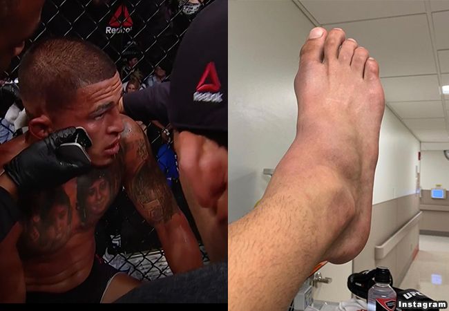 UFC: Anthony Pettis brak voet in gevecht met Nate Diaz