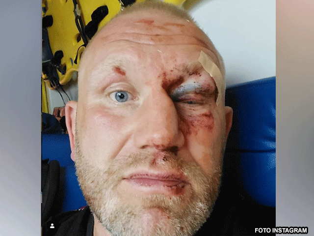 MMA-vechter spreekt over vechtpartij in hotel: 'Mijn oogkas is gebroken'
