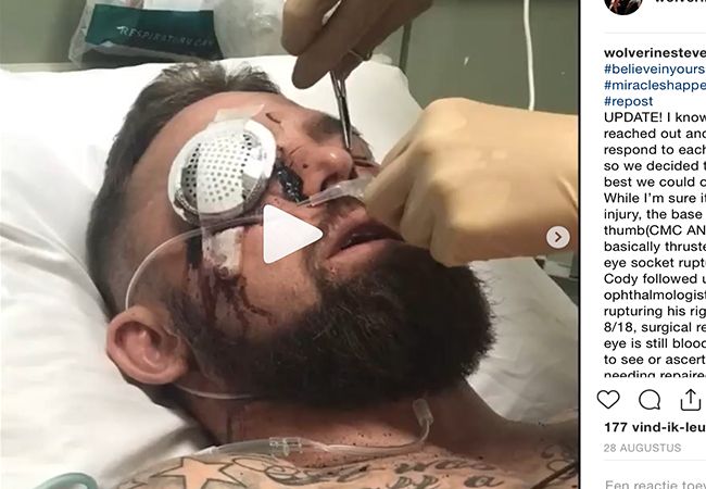 MMA vechter blind na scheuren oog tijdens gevecht