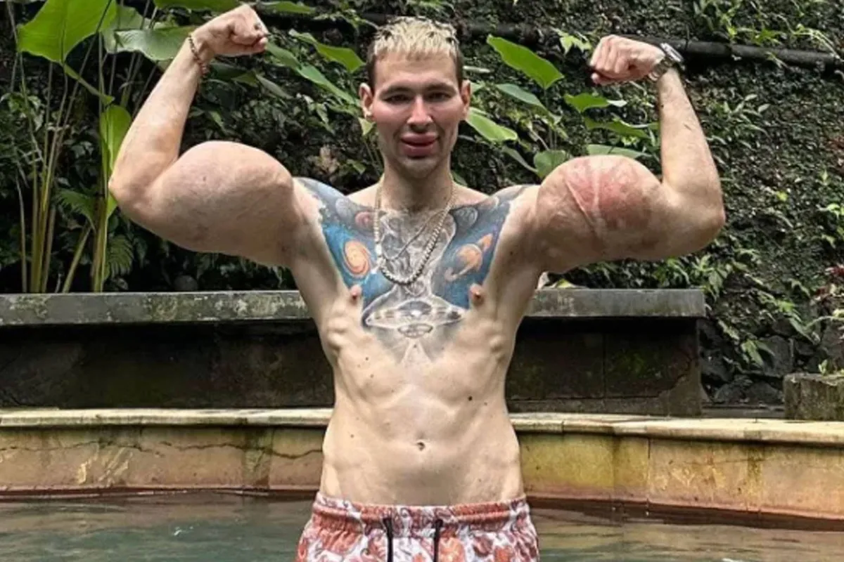 Dokters vrezen voor leven MMA-vechter ‘Popeye’ - amputatie opgeblazen armen?