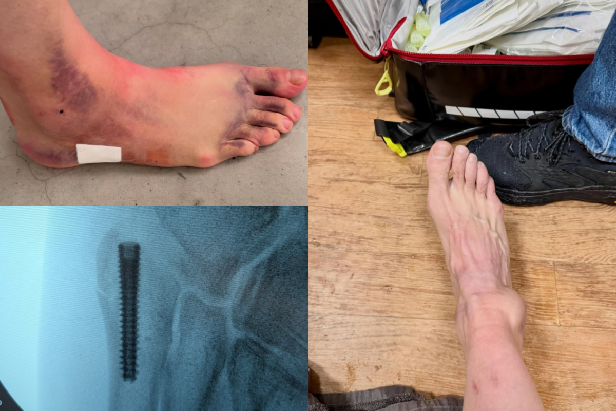 📸 Van Aert takes first 'victory' on the bike in 2026, but photos of ankle fracture prove severity of the issue