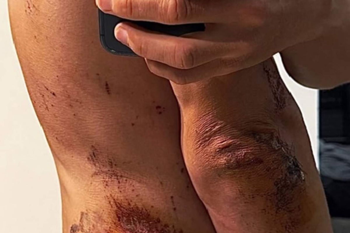 No broken bones, but Kwiatkowski shares grim images of heavy Milan-San Remo crash damage