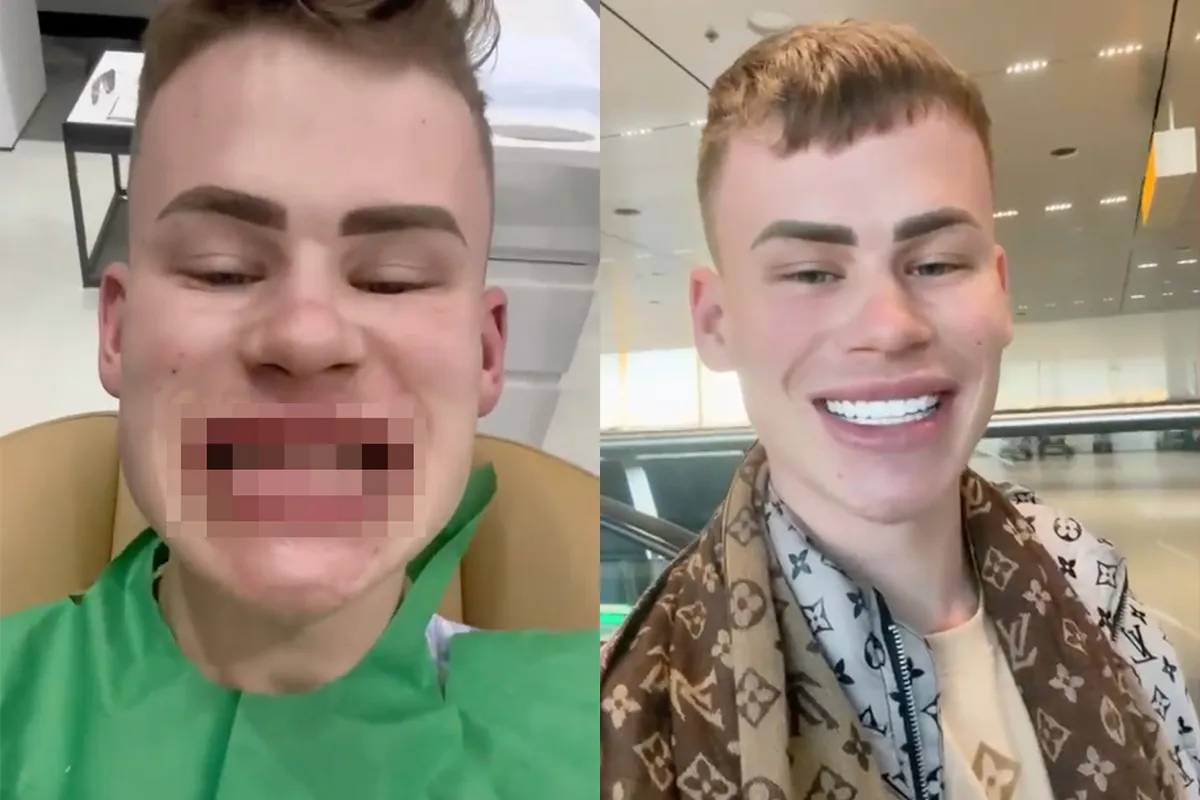 Fenomeen Ziggy Krassenberg heeft nieuwe tanden gehaald in Turkije