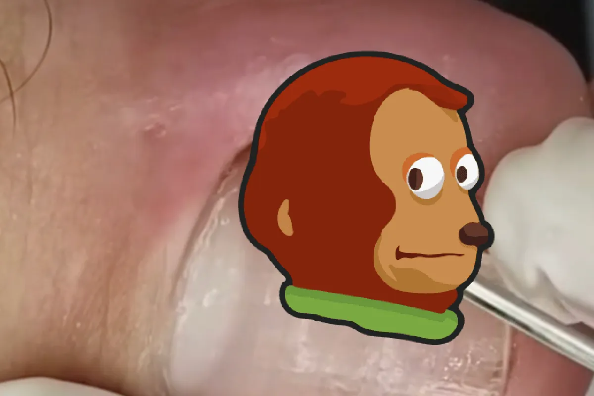 Voor de liefhebbers: het verwijderen van een ingegroeide teennagel