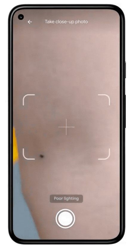 Zo gaat Google jou helpen om huidkanker op te sporen