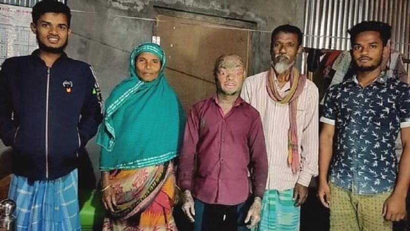 'Slangenman' Majibar lijdt aan het 'rode man syndroom' waardoor zijn huid helemaal afschilfert