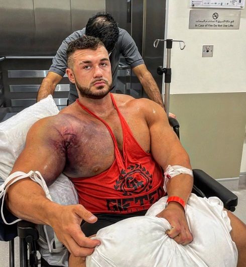 Horrorblessure voor bodybuilder wanneer spier van bot scheurt bij het bankdrukken (video)
