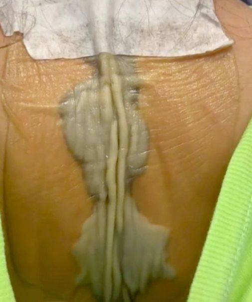 Jongedame gaat met nieuwe tattoo meteen zonnebaden en zwemmen, met dramatische gevolgen