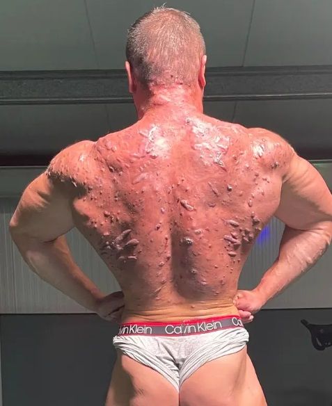 Bodybuilder toont ernstige schade die steroïden aan zijn lichaam hebben toegebracht