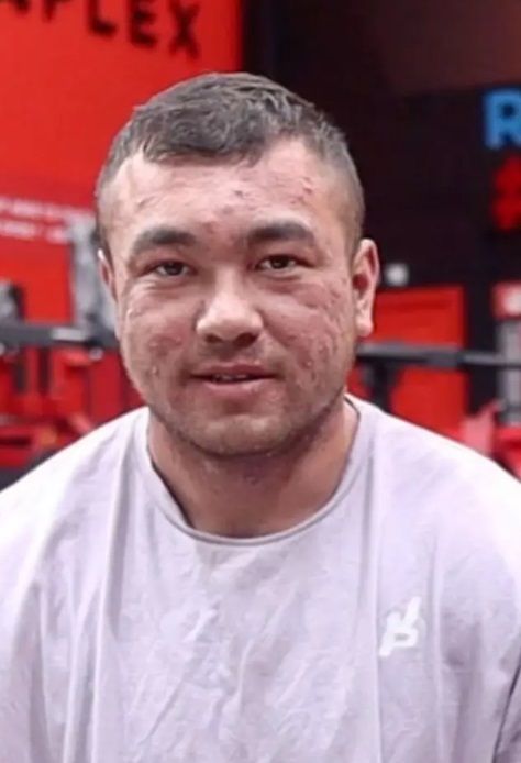 Bodybuilder toont ernstige schade die steroïden aan zijn lichaam hebben toegebracht
