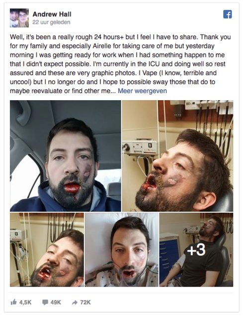 Elektronische sigaret ontploft in kerel zijn muil (video)