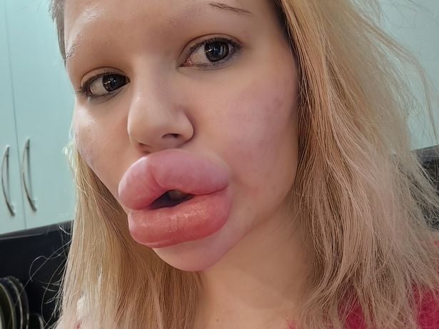 Vrouw met 'de grootste lippen ter wereld' worstelt om de liefde te vinden ondanks huwelijksaanzoeken
