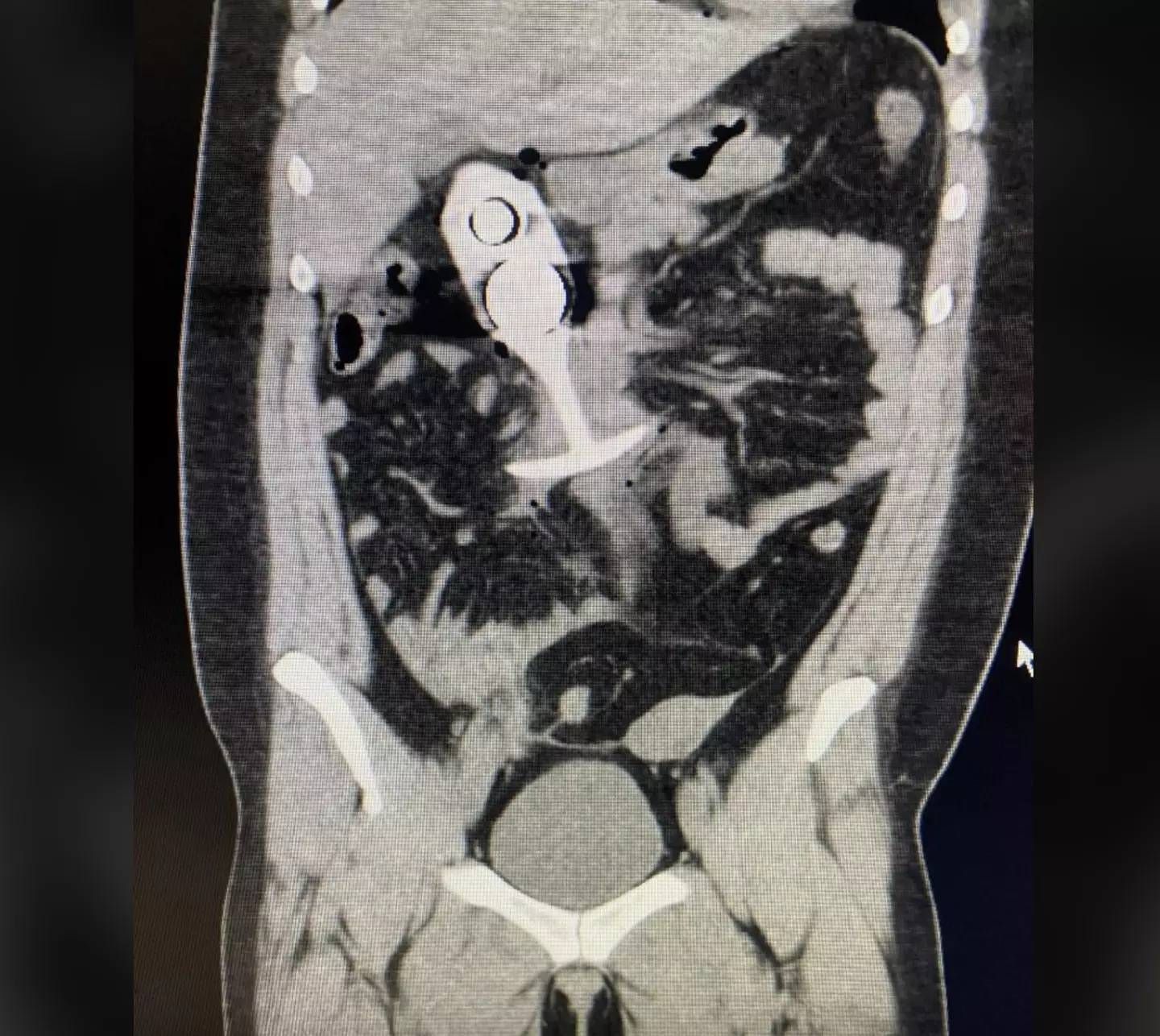 Vrouw laat een 'pikant' speeltje in haar achterste zitten tijdens een MRI en dat loopt dramatisch af