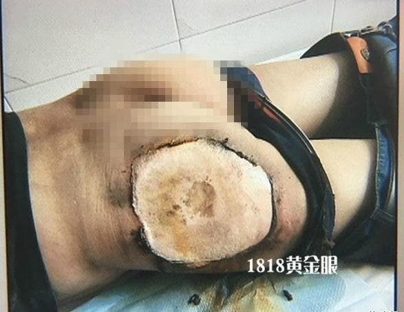 Alleged Xiaomi Mi 4c explodes, leaving user injured on the... backside (NSFW)