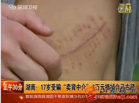 Chinese Teen Sells His Right Kidney For iPad 2!