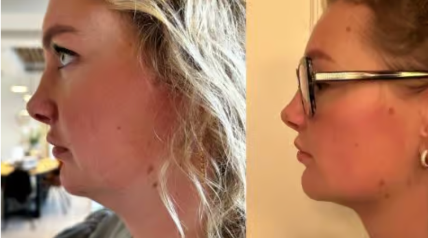 Maxime Meiland verandert haar uiterlijk door middel van cosmetische ingreep: check de 'voor en na' foto's!
