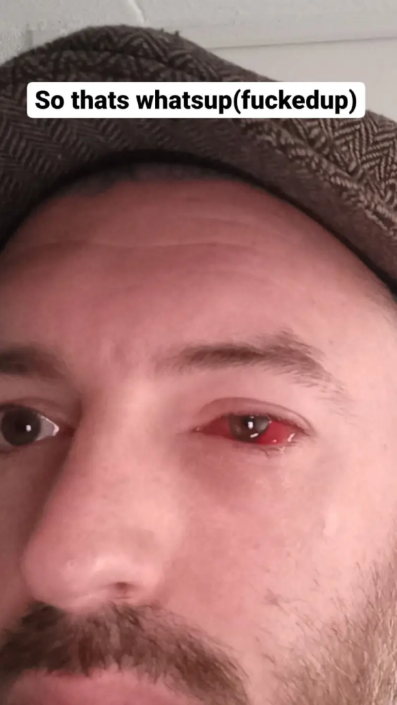 Ben Saunders deelt een heftige foto van aandoening aan gezicht