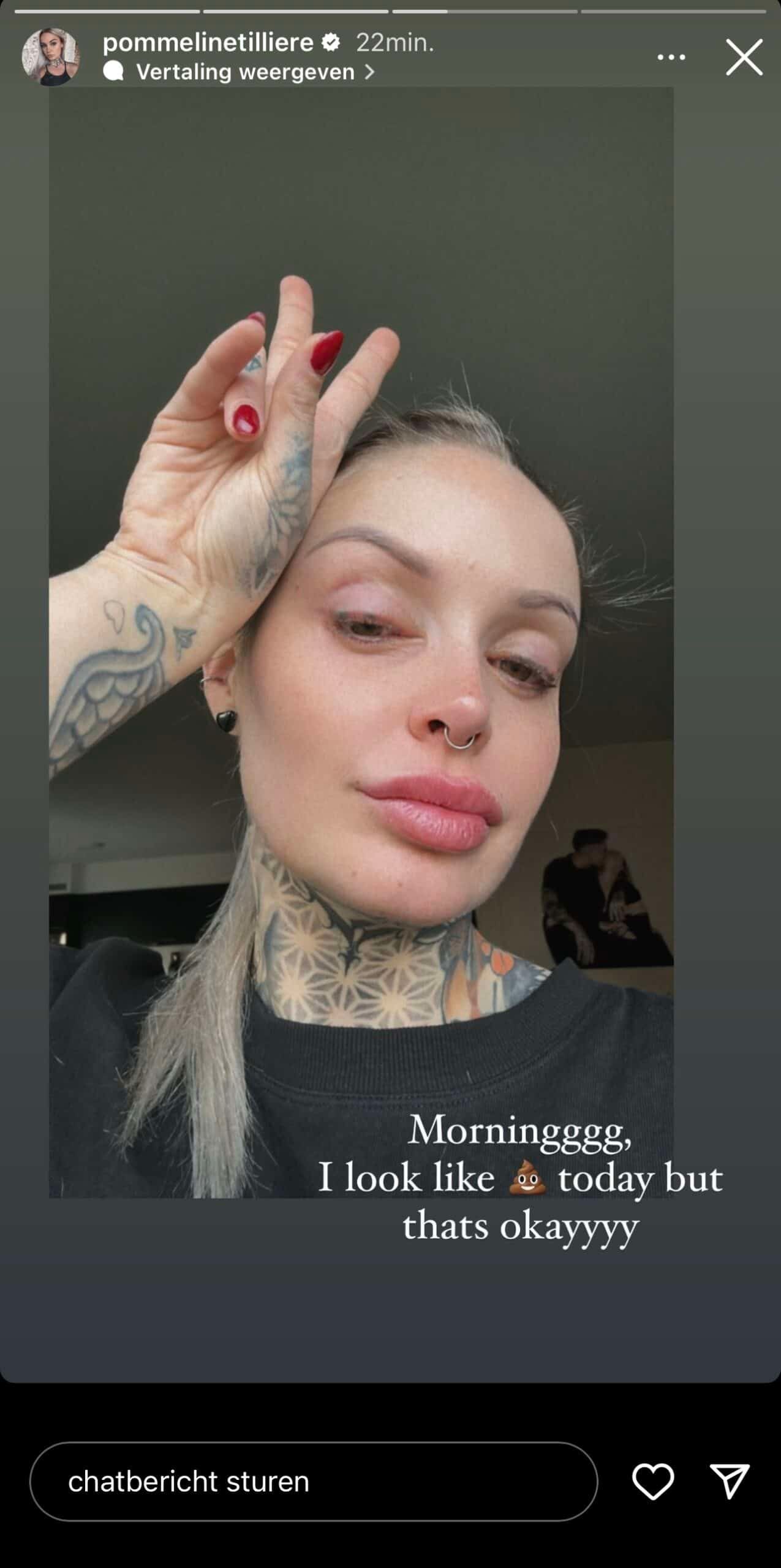 "Ik zie er niet uit!": 'Temptation'-Pommeline deelt eerlijke foto dag na pijnlijke laserbehandeling