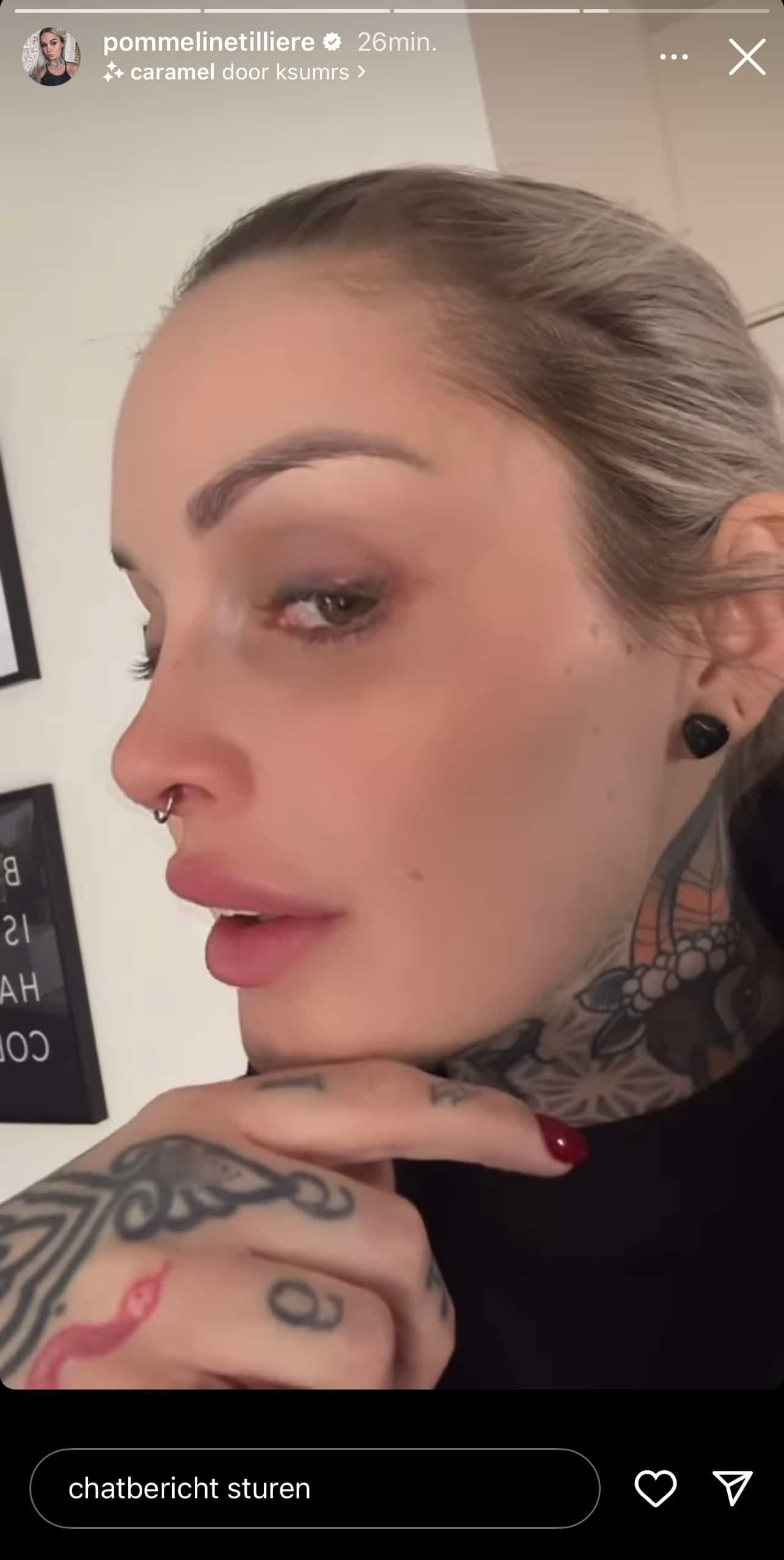 "Ik zie er niet uit!": 'Temptation'-Pommeline deelt eerlijke foto dag na pijnlijke laserbehandeling