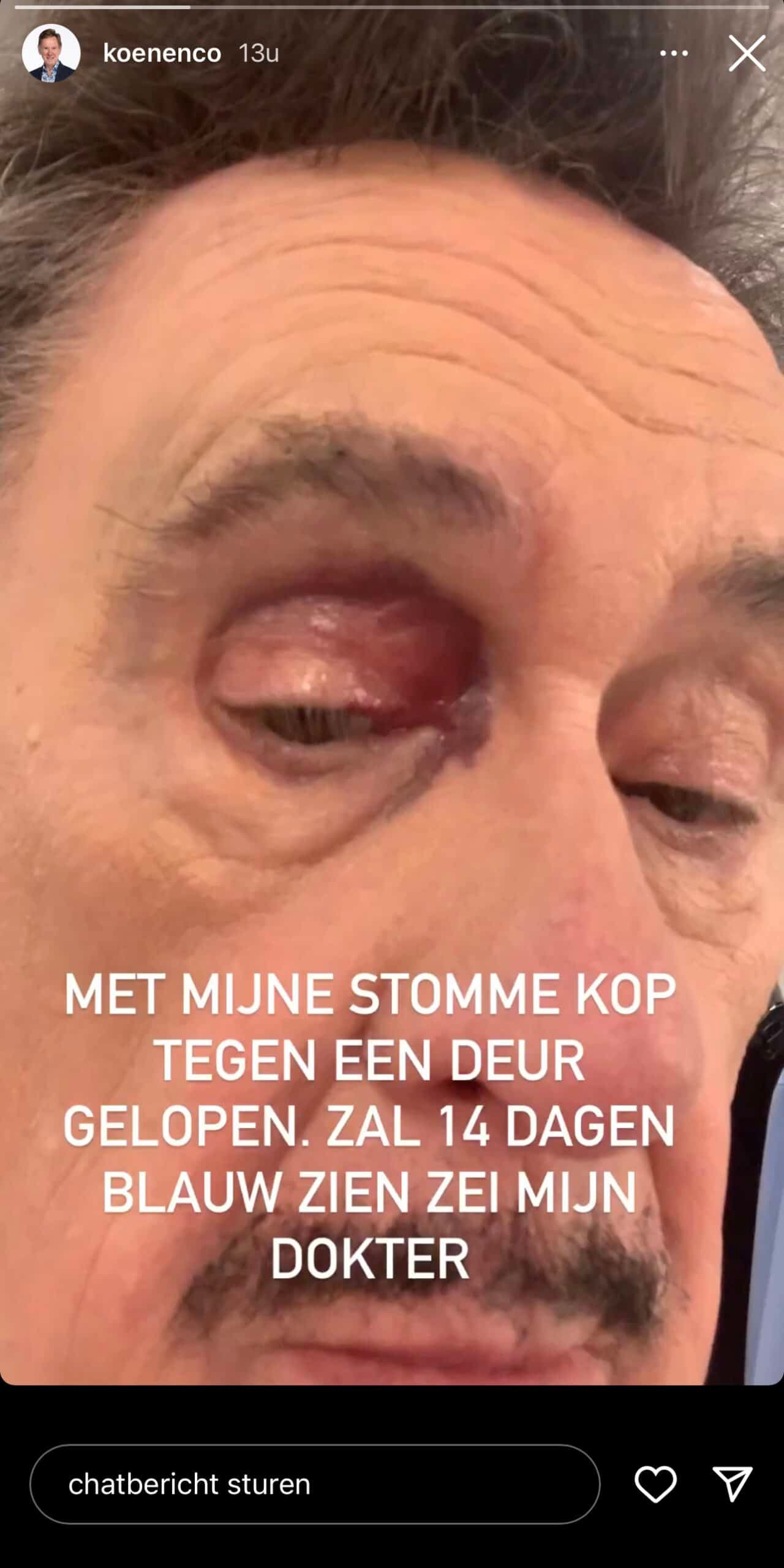 Na delicate operatie heeft Koen Crucke opnieuw slecht nieuws te melden over zijn oog: “Stomme kop”