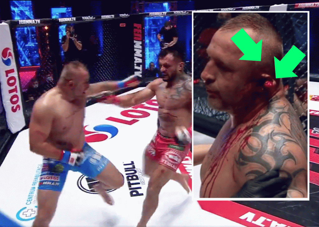 FLAPPIE: Dokter stopt heftig MMA-gevecht vanwege loshangend oor (video)