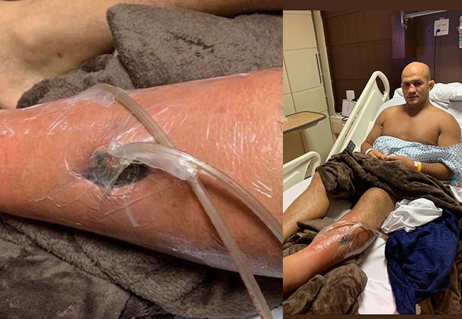 UFC-vechter Dos Santos deelt foto van horror infectie (beelden)