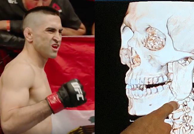 Zwaar letsel: UFC-vechter Ricardo Lamas flink gehavend na gevecht