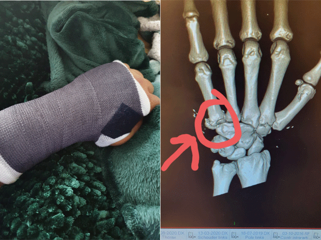 GEBROKEN HAND: MMA-vechter Maruan Belgharbi pakt winst bij Enfusion