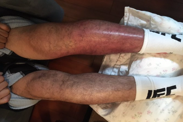 Blessures in vechtsport wat zijn de lange termijn gevolgen? En speelt geld een rol?