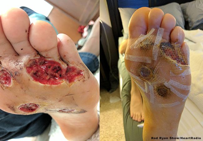 Vervelende infecties die je oploopt in de sportschool