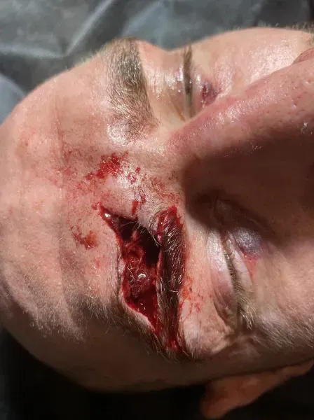 🎥 Gruwelijke wond bij MMA-vechter schokt fans na waanzinnig gevecht