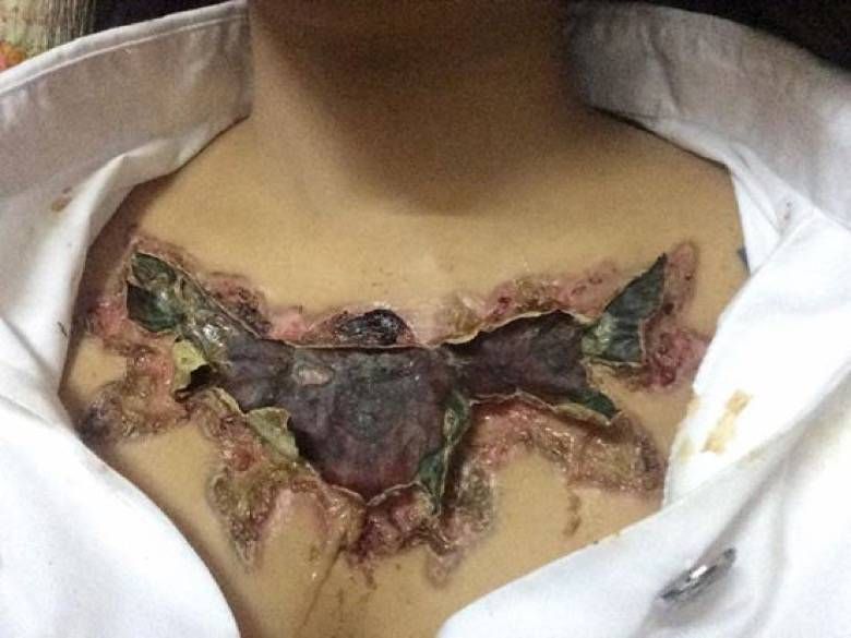 21-jarige Thaise dacht haar tattoo even te verwijderen