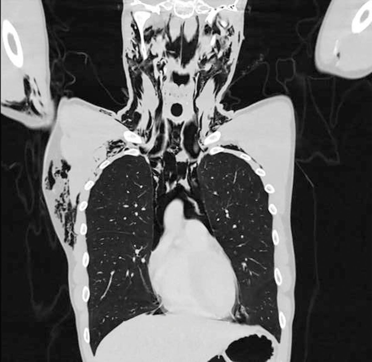 Pas op: Zwitserse man krijgt longproblemen door te hard masturberen