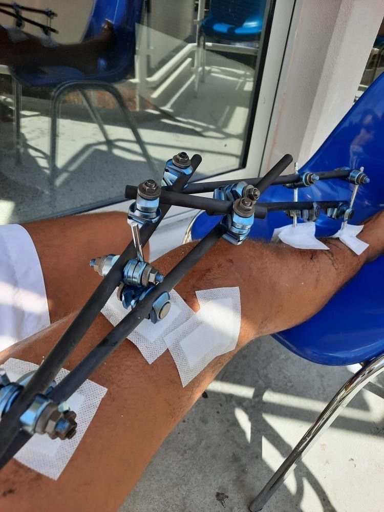 Jesse houdt verbrijzeld been over na sussen vechtpartij in Chersonissos