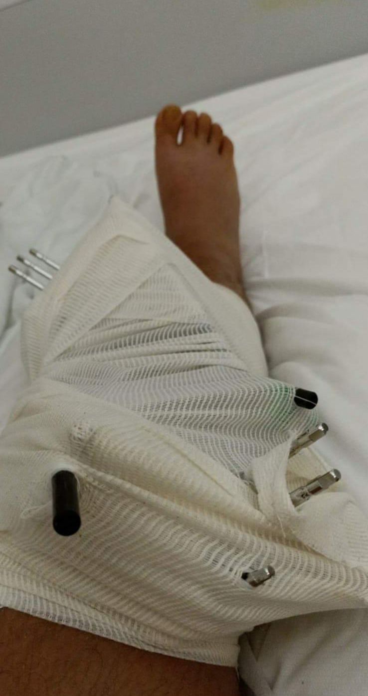 Jesse houdt verbrijzeld been over na sussen vechtpartij in Chersonissos